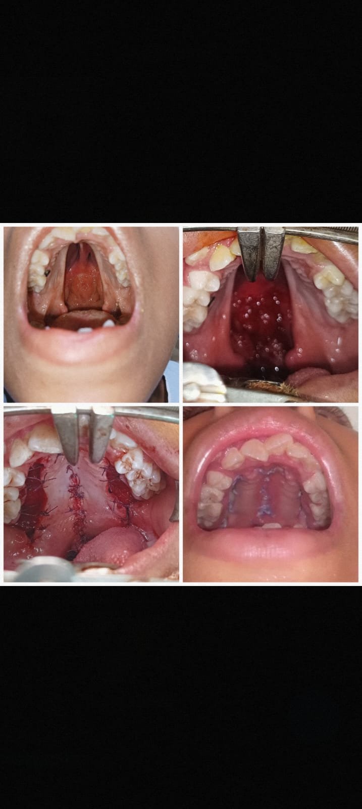 cleft palate  before and after